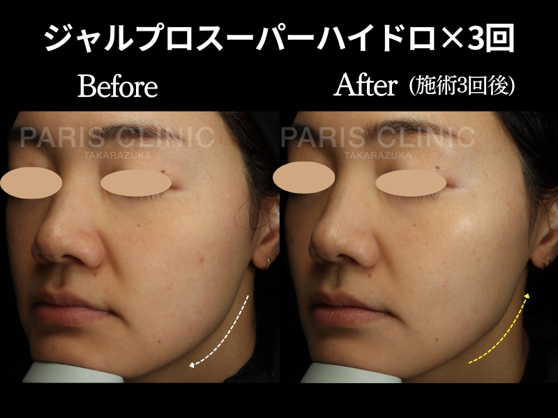 ジャルプロ スーパーハイドロ症例