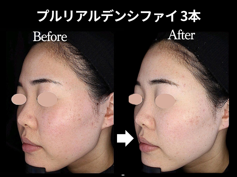 プルリアル デンシファイ症例