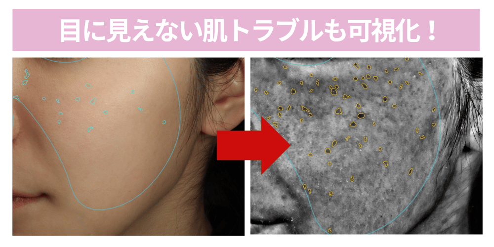 VISIA肌診断 診断結果