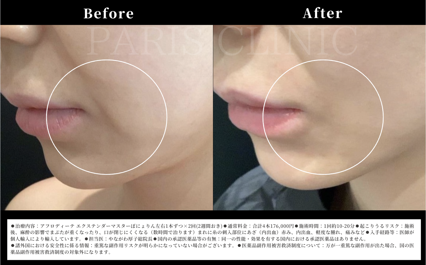 ぽにょりんBefore/After